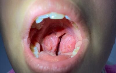 Cirurgia de Amígdalas e Adenoide: Os 7 sintomas mais comuns na recuperação pós-operatória