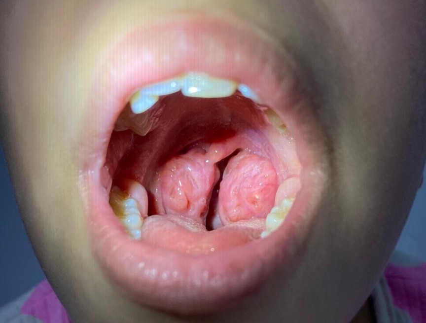 Cirurgia de Amígdalas e Adenoide: Os 7 sintomas mais comuns na recuperação pós-operatória