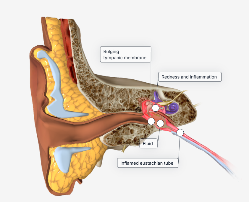 orelha média com liquido em sem interior, gerando otite média aguda serosa